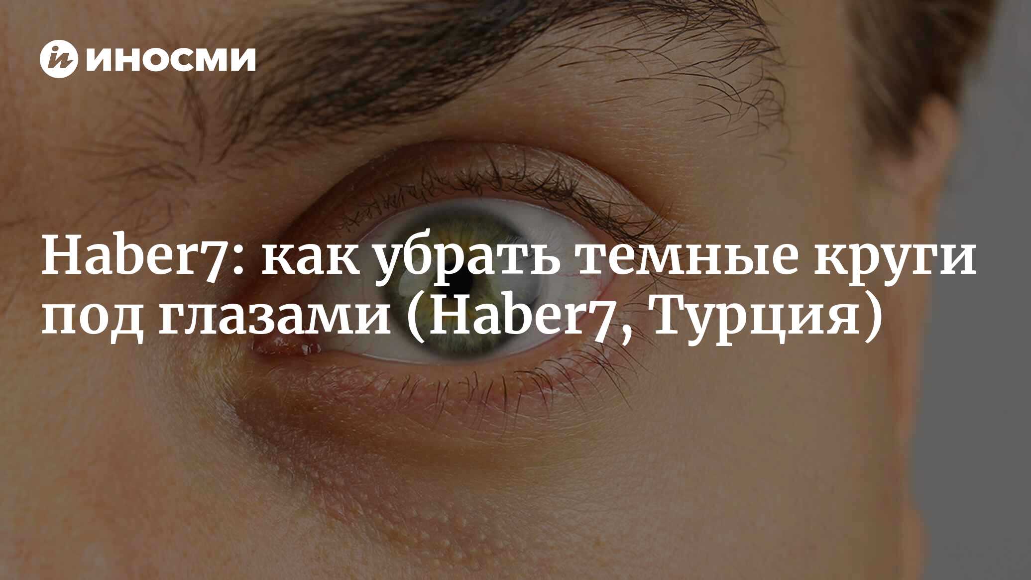 Haber7 (Турция): как убрать синяки под глазами? Натуральные средства  лечения (Haber7, Турция) | 07.10.2022, ИноСМИ