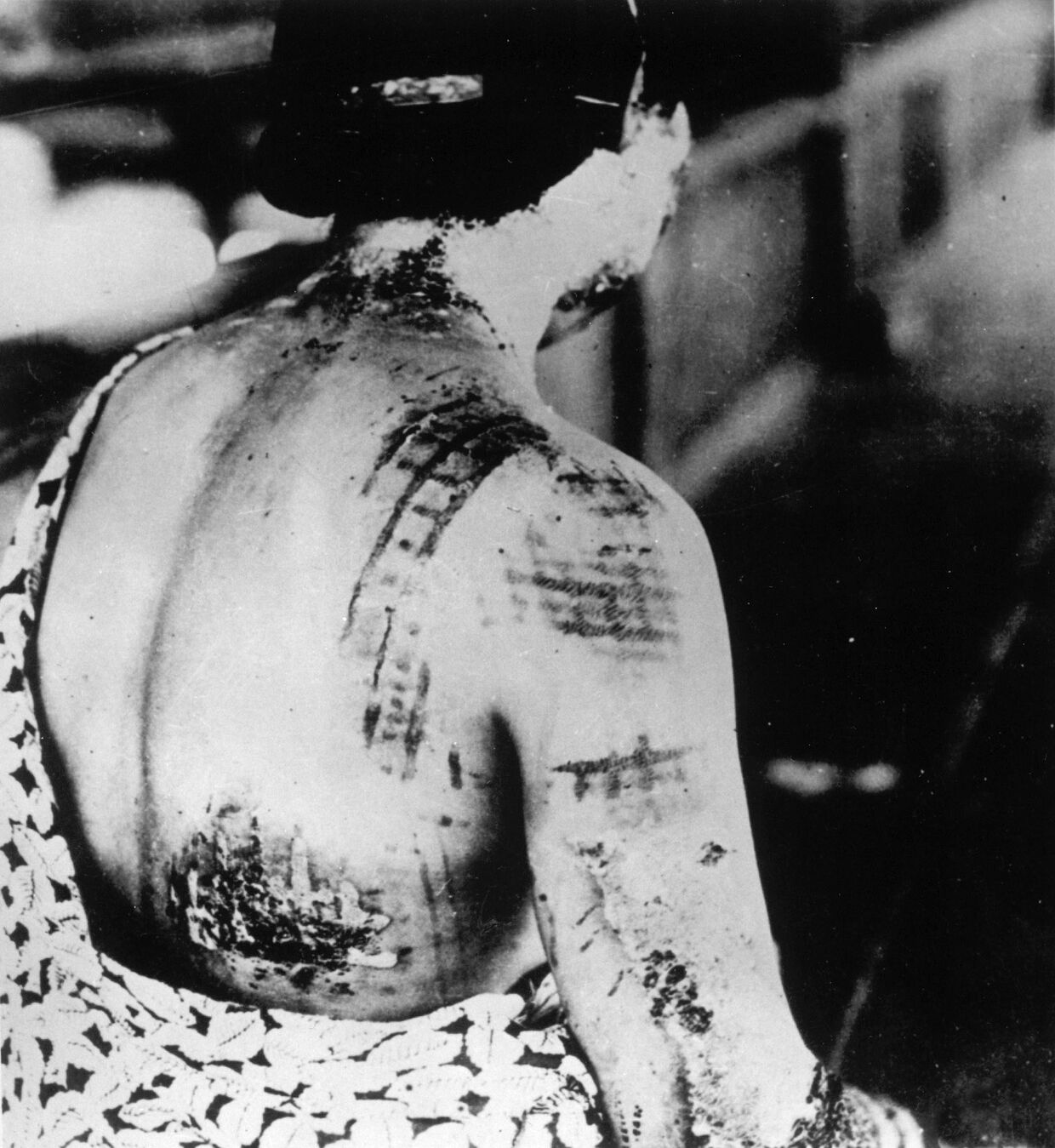 На коже женщины, пережившей бомбардировку Хиросимы, отпечатался рисунок ее кимоно