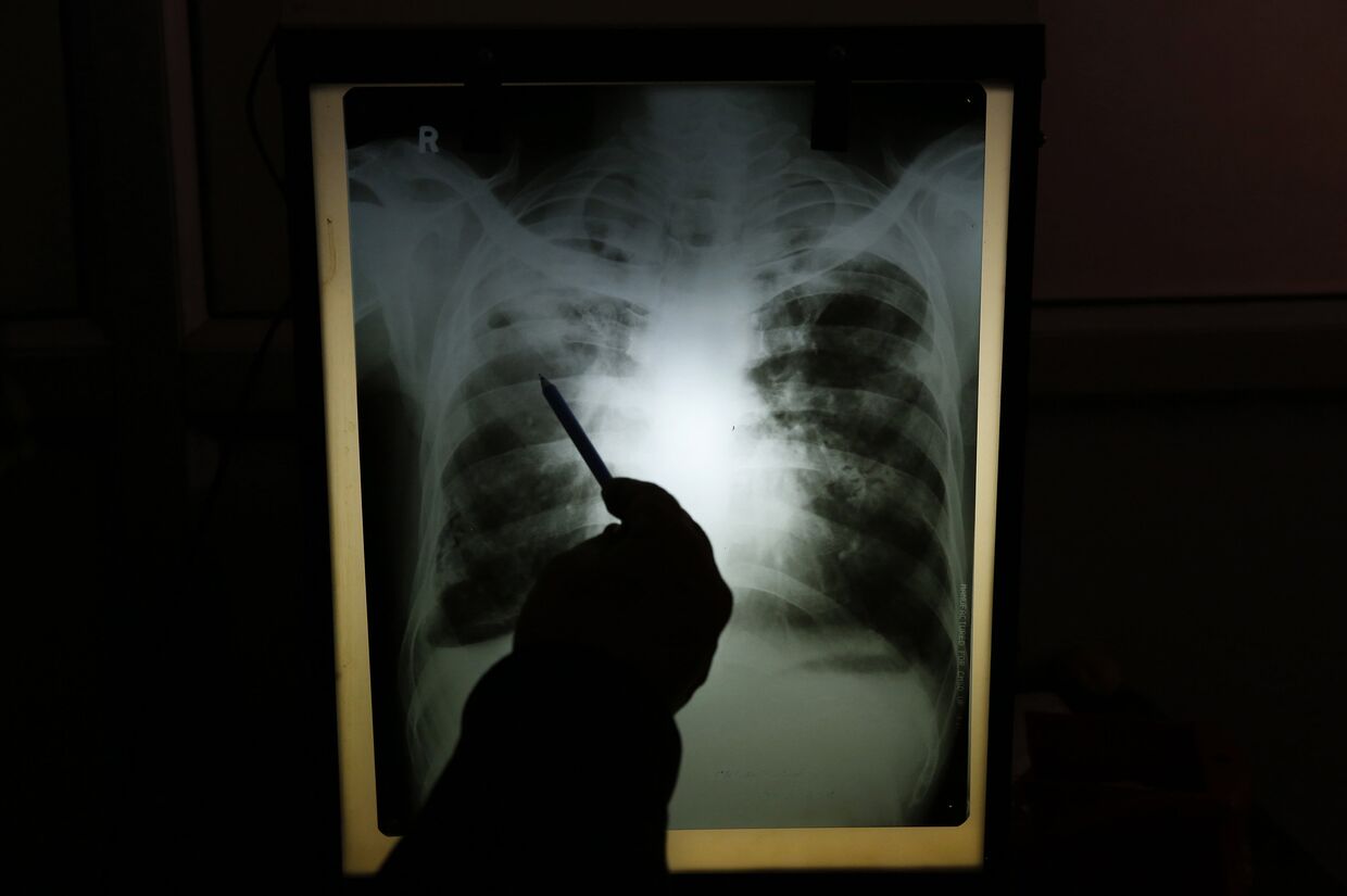 Результаты рентгенографии пациента с подозрением на туберкулез