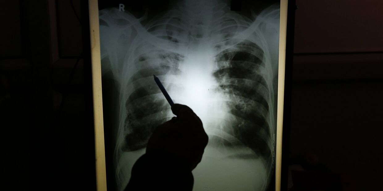 Результаты рентгенографии пациента с подозрением на туберкулез