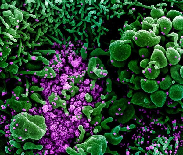 Коронавирус (окрашен фиолетовым) атакует клетки в организме заболевшего