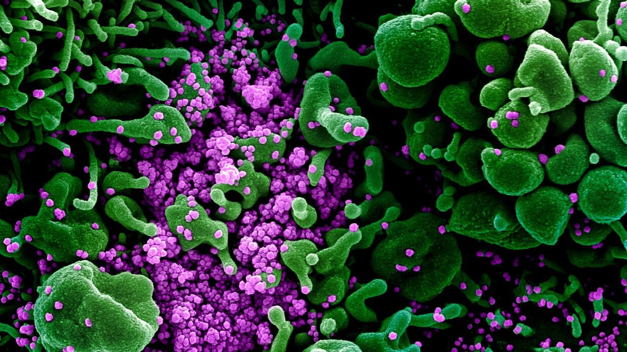 Коронавирус (окрашен фиолетовым) атакует клетки в организме заболевшего