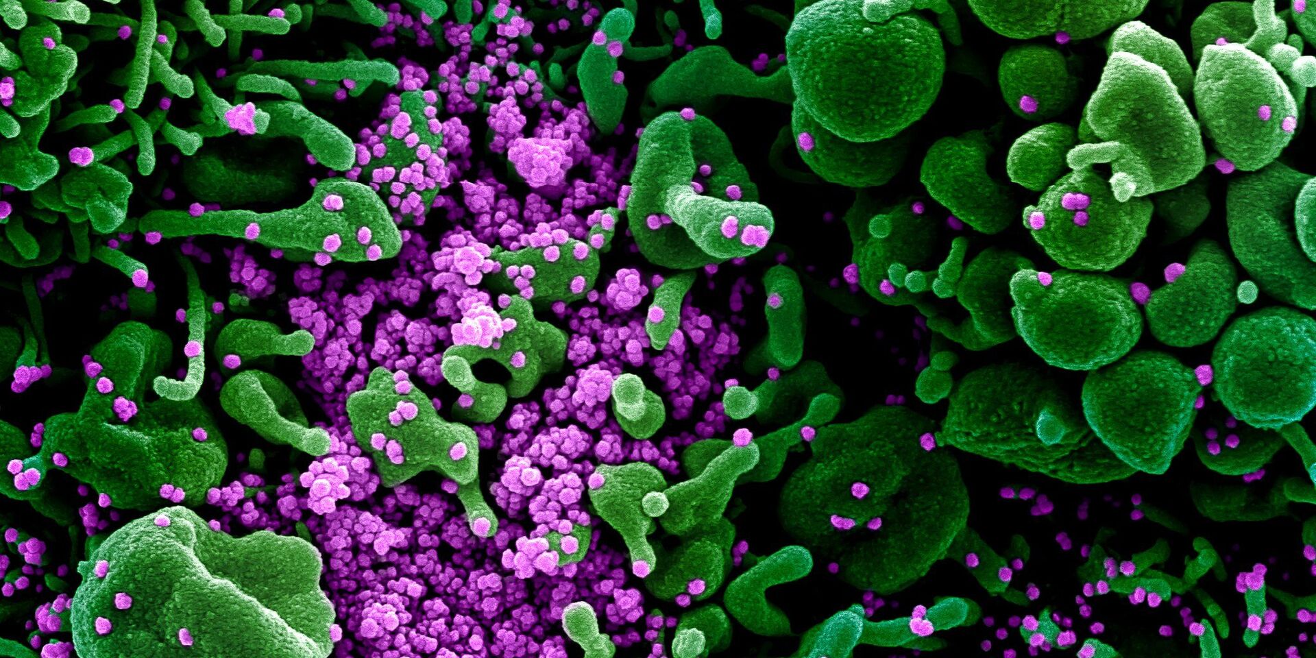 Коронавирус (окрашен фиолетовым) атакует клетки в организме заболевшего - ИноСМИ, 1920, 12.02.2022