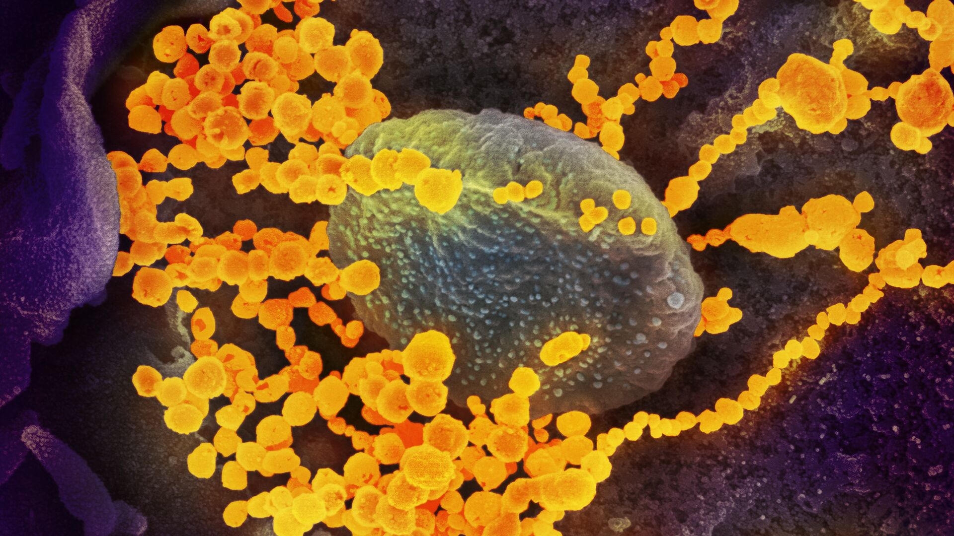 SARS-CoV-2 (окрашен желтым) атакует клетки, культивируемые в лаборатории - ИноСМИ, 1920, 20.10.2022