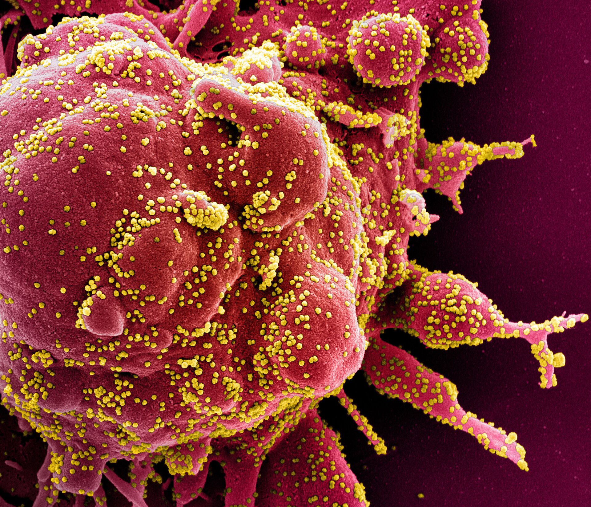 Коронавирус (окрашен желтым) атакует клетки в организме заболевшего - ИноСМИ, 1920, 09.07.2021