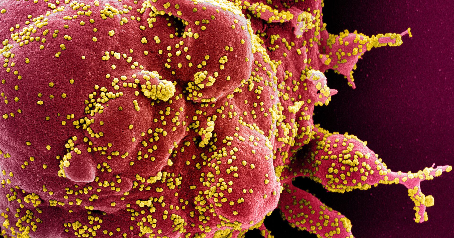 Коронавирус (окрашен желтым) атакует клетки в организме заболевшего - ИноСМИ, 1920, 21.02.2021