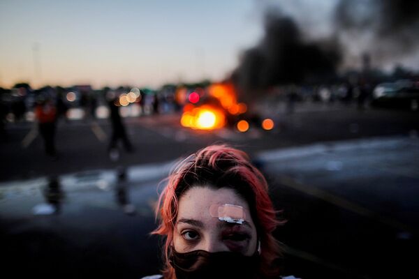 Участница акций протеста в Миннеаполисе, пострадавшая от резиновых пуль во время столкновений с полицией