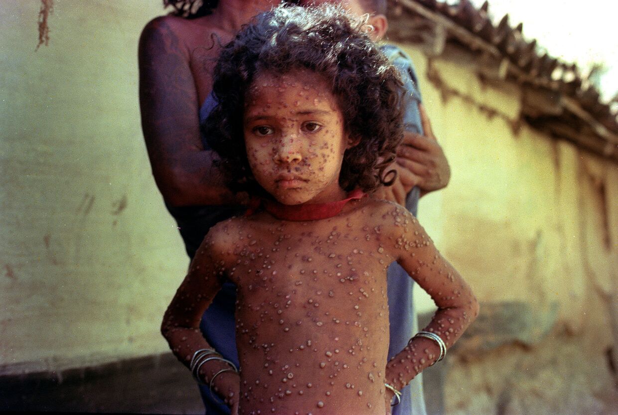 1974, Индия. Ребенок, больной натуральной оспой