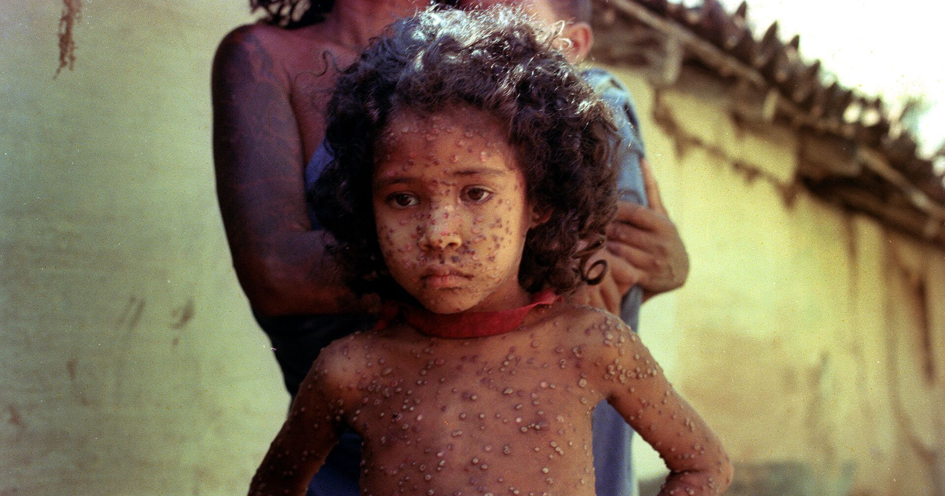 1974, Индия. Ребенок, больной натуральной оспой - ИноСМИ, 1920, 10.07.2021