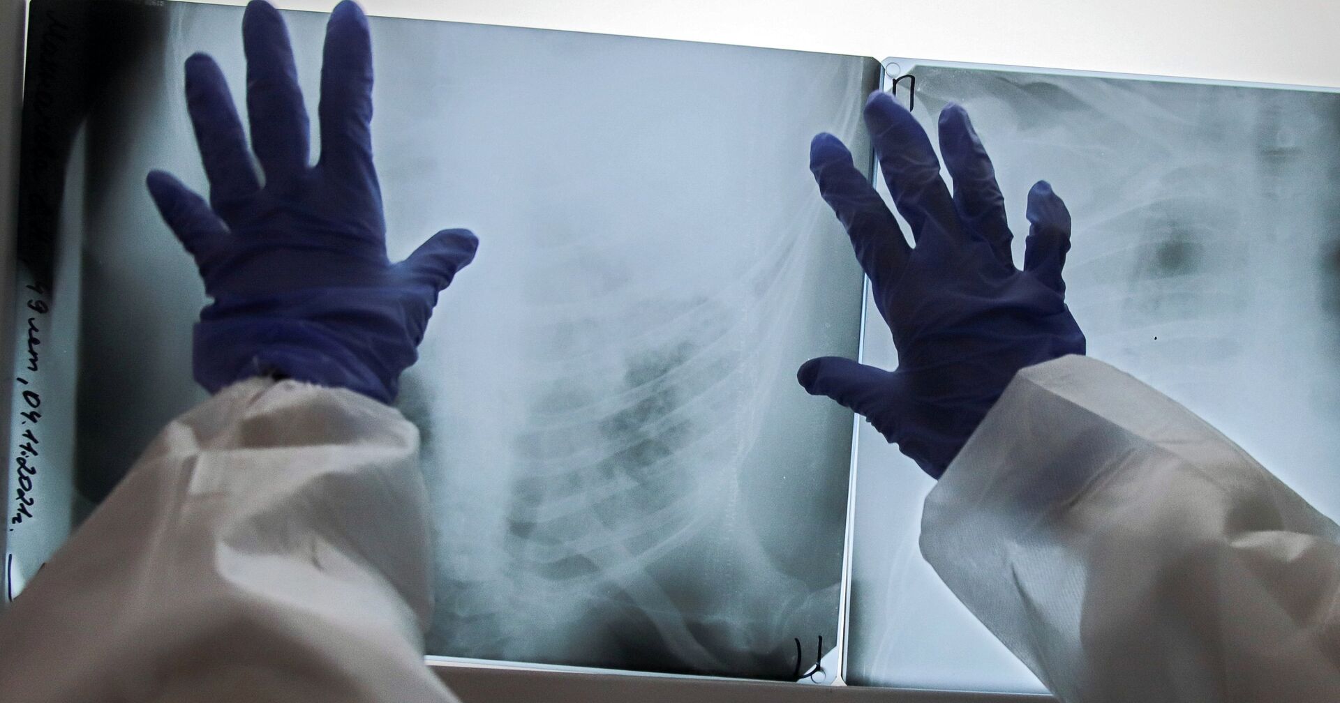 Медик смотрит рентгеновский снимок легких пациента - ИноСМИ, 1920, 08.01.2022