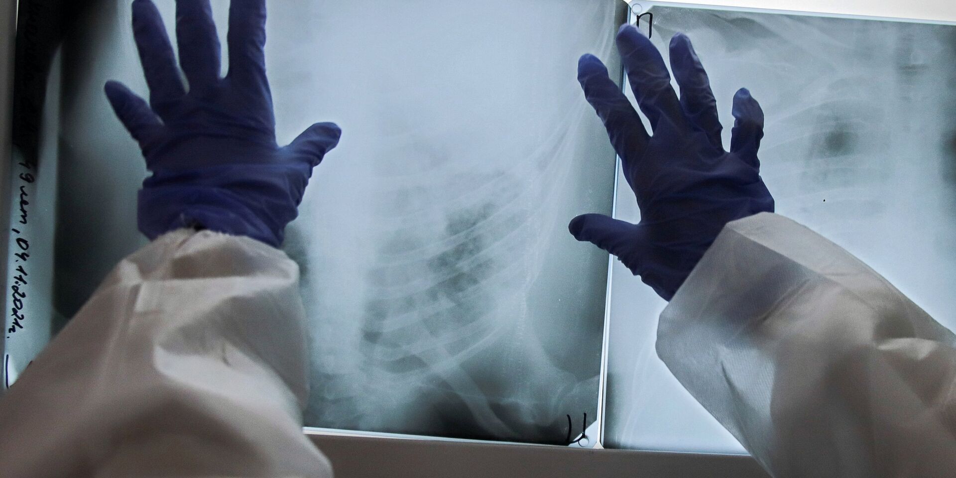 Медик смотрит рентгеновский снимок легких пациента - ИноСМИ, 1920, 07.04.2022